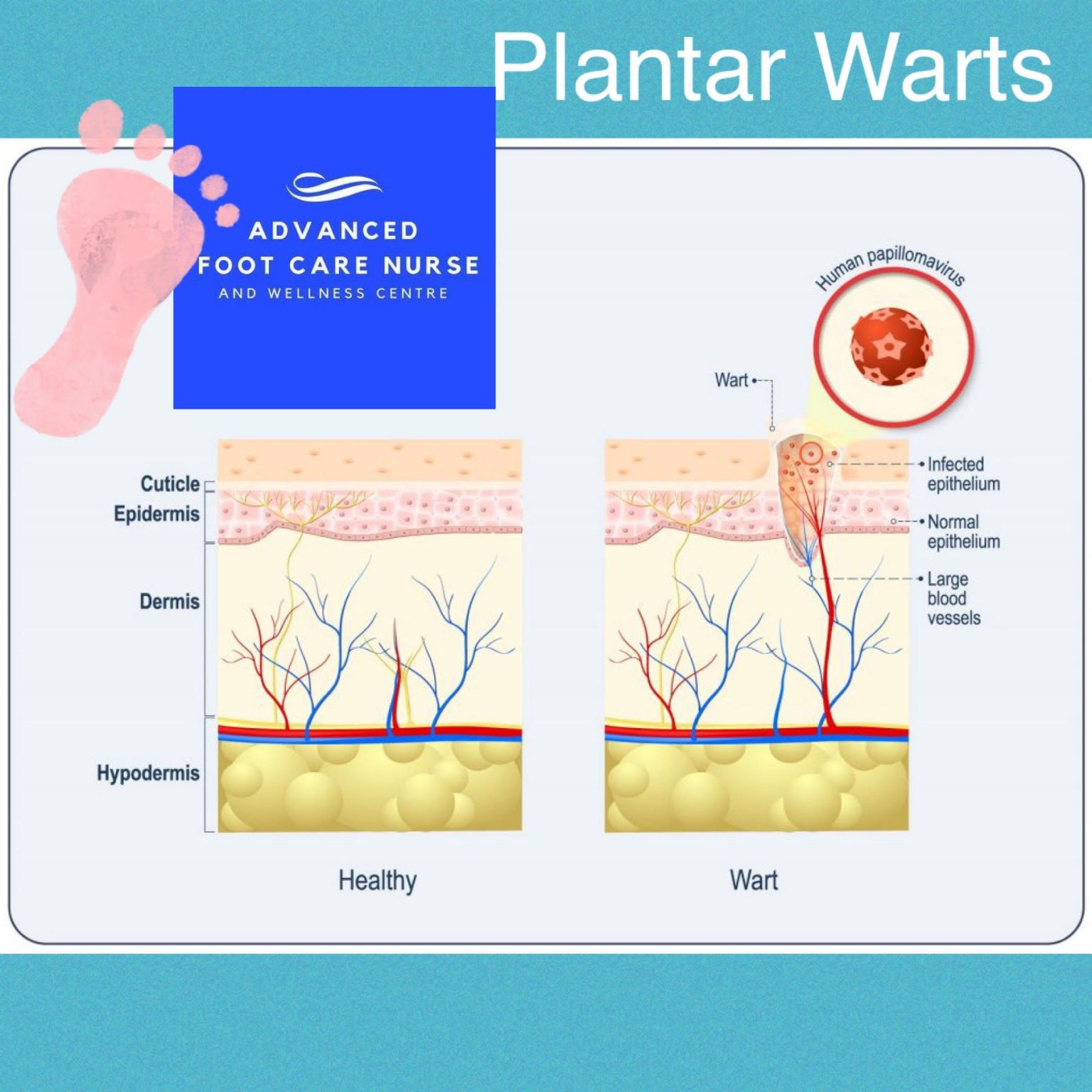 pulled out plantar wart root