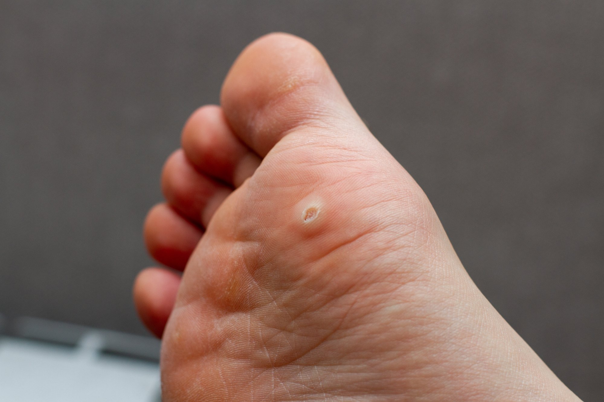 pulled out plantar wart root